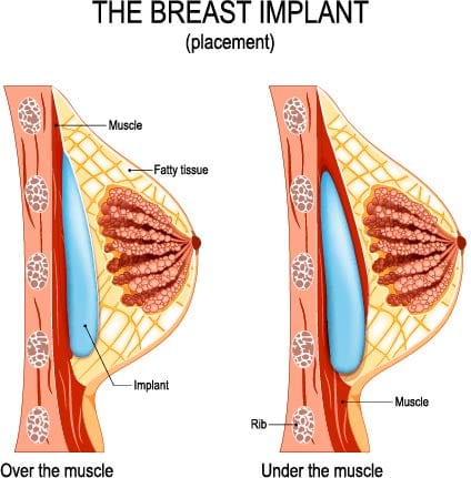 breast implant placement illustration