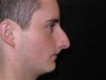 Nose Surgery - Case Case 1 - Before