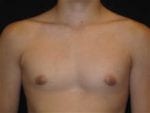 Male Breast Reduction - Case Case 1 - After