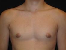Male Breast Reduction Patient Photo - Case Case 1 - after view-0