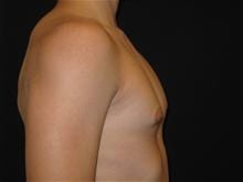 Male Breast Reduction Patient Photo - Case Case 1 - after view-1