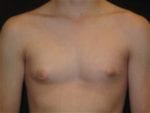Male Breast Reduction - Case Case 1 - Before