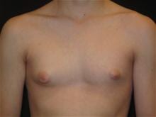 Male Breast Reduction Patient Photo - Case Case 1 - before view-0
