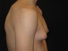 Male Breast Reduction Patient Photo - Case Case 1 - before view-1