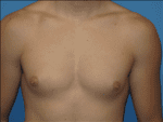 Male Breast Reduction - Case Case 2 - Before
