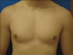 Male Breast Reduction - Case Case 2 - After