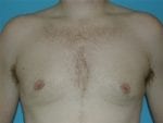 Male Breast Reduction - Case Case 3 - After