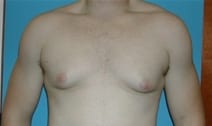 Male Breast Reduction Patient Photo - Case Case 3 - before view-0