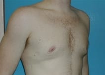 Male Breast Reduction Patient Photo - Case Case 3 - after view-1