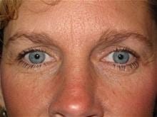 Eyelid Surgery Patient Photo - Case Case 1 - after view-0