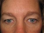 Eyelid Surgery - Case Case 1 - Before