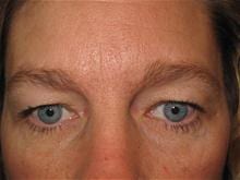 Eyelid Surgery Patient Photo - Case Case 1 - before view-0