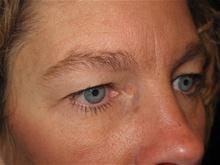 Eyelid Surgery Patient Photo - Case Case 1 - before view-1