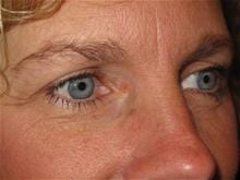 Eyelid Surgery Patient Photo - Case Case 1 - after view-1