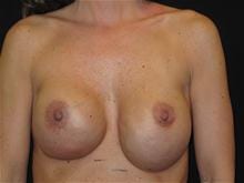 Breast Implant Revision Patient Photo - Case Case 1 - before view-