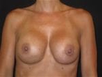 Breast Implant Revision - Case Case 1 - After