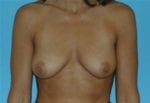 Breast Augmentation - Case Case 7 - Before
