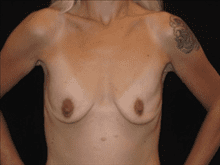 Breast Augmentation Patient Photo - Case Case 9 - before view-0