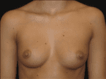 Breast Augmentation - Case Case 10 - Before