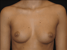 Breast Augmentation Patient Photo - Case Case 10 - before view-0