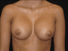 Breast Augmentation Patient Photo - Case Case 10 - after view