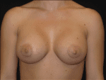 Breast Augmentation - Case Case 12 - After