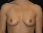 Breast Augmentation - Case Case 12 - Before