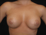 Breast Augmentation - Case Case 13 - After