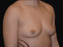 Breast Augmentation Patient Photo - Case Case 14 - before view-1