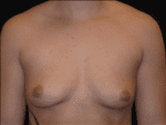 Breast Augmentation - Case Case 14 - Before