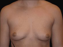 Breast Augmentation Patient Photo - Case Case 14 - before view-0