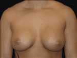 Breast Augmentation - Case Case 14 - After