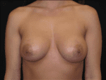 Breast Augmentation - Case Case 15 - After