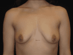 Breast Augmentation - Case Case 15 - Before