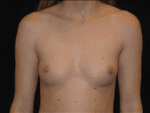 Breast Augmentation - Case Case 16 - Before