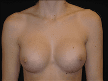 Breast Augmentation Patient Photo - Case Case 16 - after view-0