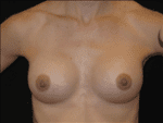 Breast Augmentation - Case Case 17 - After
