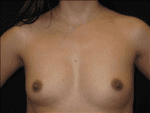 Breast Augmentation - Case Case 18 - Before