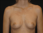 Breast Augmentation - Case Case 19 - Before