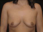 Breast Augmentation - Case Case 20 - Before