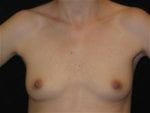Breast Augmentation - Case Case 21 - Before