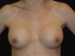 Breast Augmentation - Case Case 21 - After
