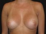 Breast Augmentation - Case Case 22 - After