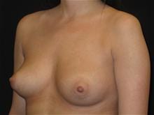 Breast Augmentation Patient Photo - Case Case 22 - before view-1