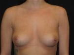 Breast Augmentation - Case Case 22 - Before
