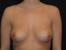 Breast Augmentation Patient Photo - Case Case 22 - before view-0