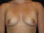 Breast Augmentation - Case Case 24 - Before
