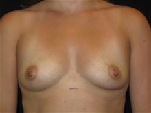 Breast Augmentation Patient Photo - Case Case 24 - before view-