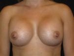 Breast Augmentation - Case Case 24 - After