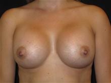 Breast Augmentation Patient Photo - Case Case 24 - after view